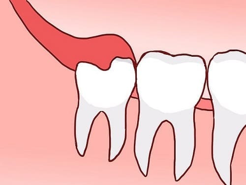 răng sâu số 8 hàm trên