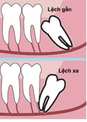 răng sâu số 8 hàm trên