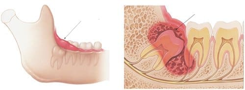 răng sâu số 8 hàm trên