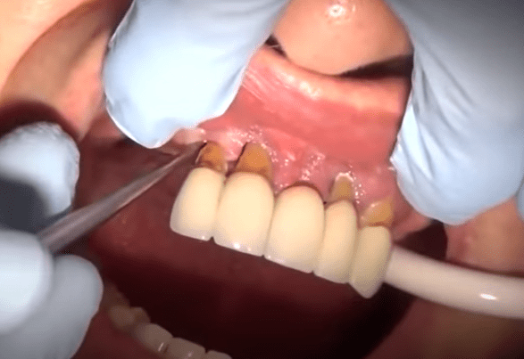 điều trị viêm nha chu