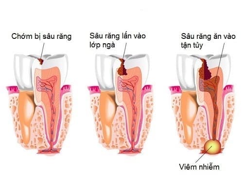 chữa đau răng sâu tại nhà
