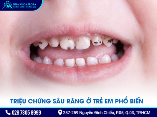 Sâu răng ở trẻ em - ảnh 2