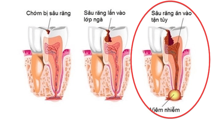 nhổ răng sâu hàm dưới