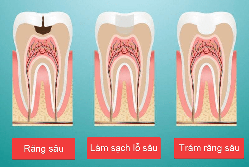 Sâu răng số 8 thi nên làm gì? Chữa trị hay Nhổ bỏ 1
