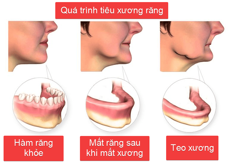 điều trị viêm nha chu