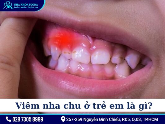 Viêm nha chu ở trẻ em - ảnh 1