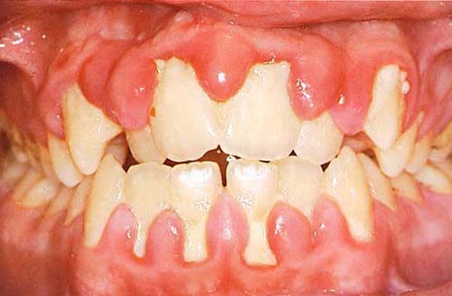 điều trị viêm nha chu