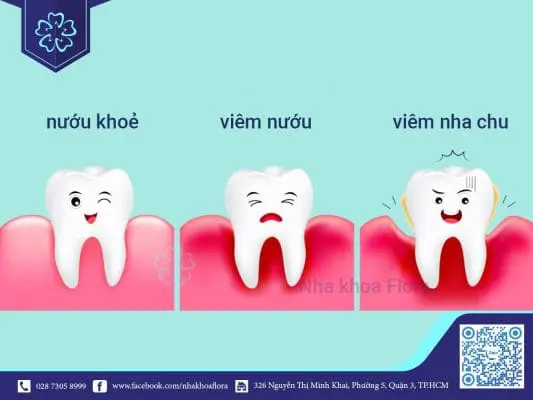 Viêm nha chu là gì? Có phải bệnh nguy hiểm không? 1