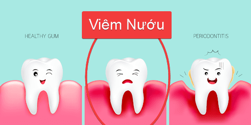 VIÊM NƯỚU VÀ VIÊM NHA CHU GIỐNG VÀ KHÁC NHAU RA SAO? 3