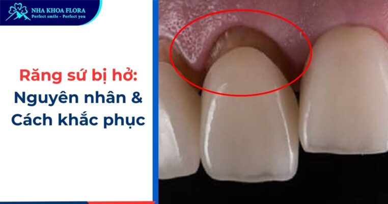 dấu hiệu răng sứ bị hở