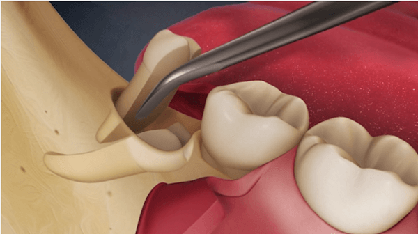 Lỗ sau khi nhổ răng khôn có nguy hiểm hay không? 4
