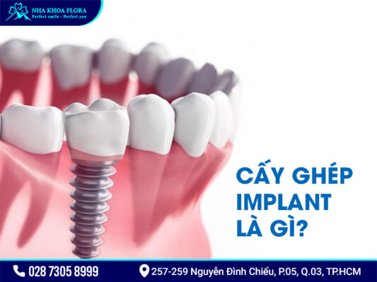 Nên cấy ghép Implant hay dùng hàm tháo lắp? - ảnh 1