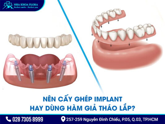 Nên cấy ghép Implant hay dùng hàm tháo lắp? - ảnh 3
