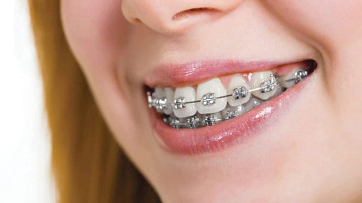 Nhổ răng khôn với mục đích thẩm mỹ như niềng răng sẽ không được bào hiểm y tế chi trả (ảnh minh họa)