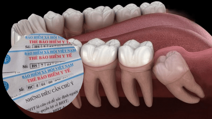 Nhổ răng khôn có được bảo hiểm y tế chi trả không? 4