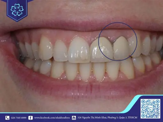 TÁC HẠI CỦA BỌC RĂNG SỨ 1