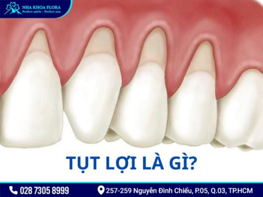 tụt lợi - ảnh 1