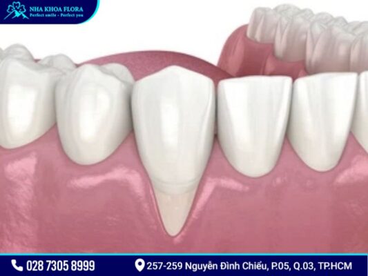 tụt lợi - ảnh 2