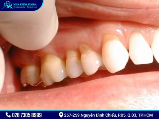 tụt lợi - ảnh 3