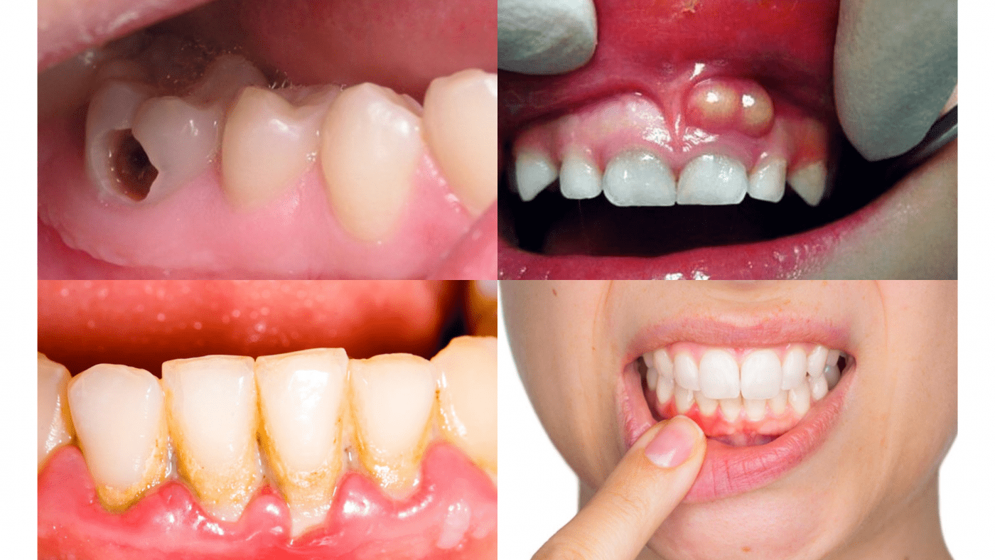 Hôi miệng nặng do các bệnh lý về răng (ảnh minh họa) Hôi miệng nặng do các bệnh lý về răng (ảnh minh họa)