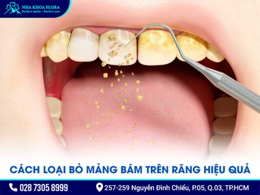 mảng bám trên răng - ảnh 3
