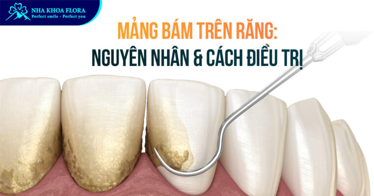 mảng bám trên răng