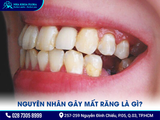 Nguyên nhân gây mất răng - ảnh 1