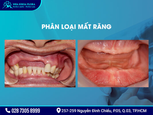 Nguyên nhân gây mất răng - ảnh 2