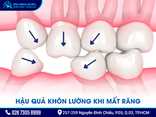 Nguyên nhân gây mất răng - ảnh 3