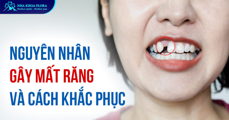 Nguyên nhân gây mất răng