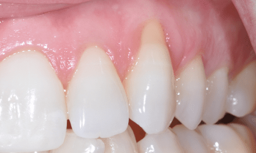 tieu-xuong-chan-rang tiêu xương chân răng