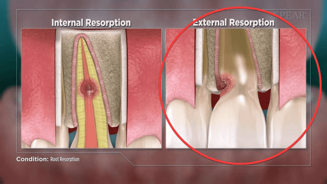 tieu-xuong-chan-rang tiêu xương chân răng