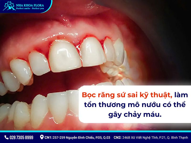 bọc răng sứ có đau không