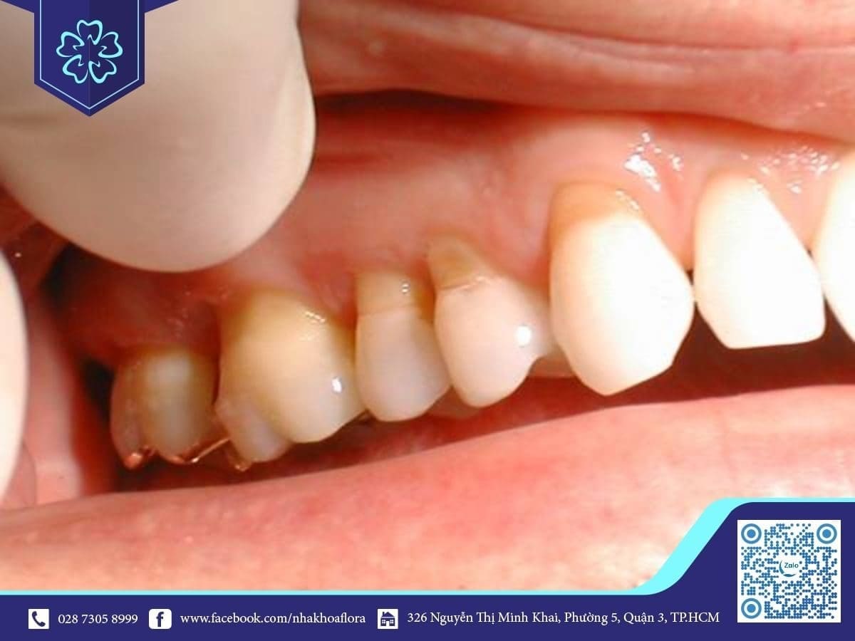 Bọc răng sứ giá rẻ gây hở cổ chân răng, mất thẩm mỹ (ảnh minh họa)