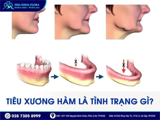 mất răng bao lâu thì bị tiêu xương hàm - ảnh 1