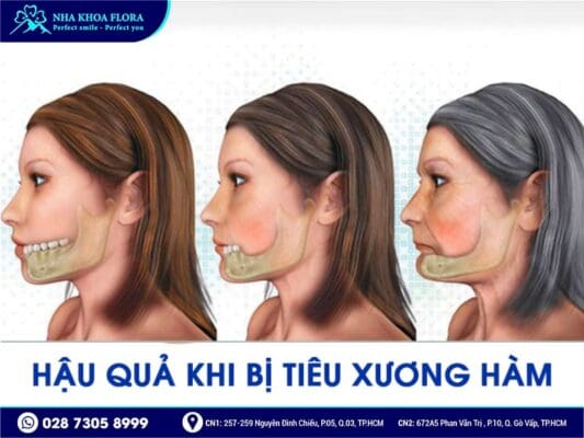 mất răng bao lâu thì bị tiêu xương hàm - ảnh 4
