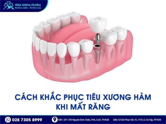 mất răng bao lâu thì bị tiêu xương hàm - ảnh 5