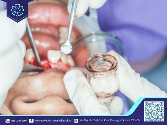 Ghép xương hàm răng nhân tạo 