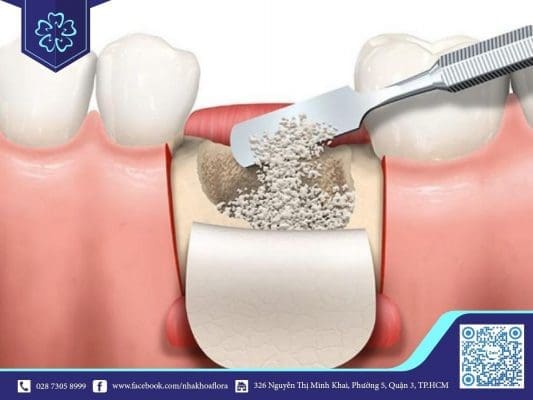 Ghép xương dị chủng (ảnh minh họa)