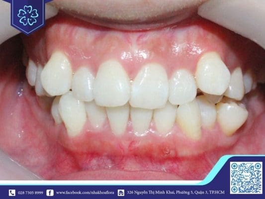 Người có răng khểnh là người như thế nào? - Ảnh 3