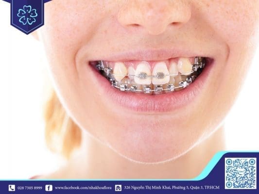 Người có răng khểnh là người như thế nào? - Ảnh 2