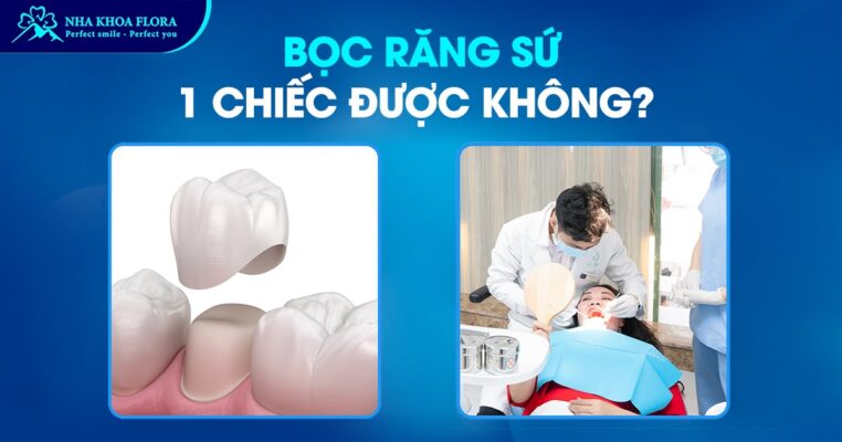 bọc răng sứ 1 chiếc được không