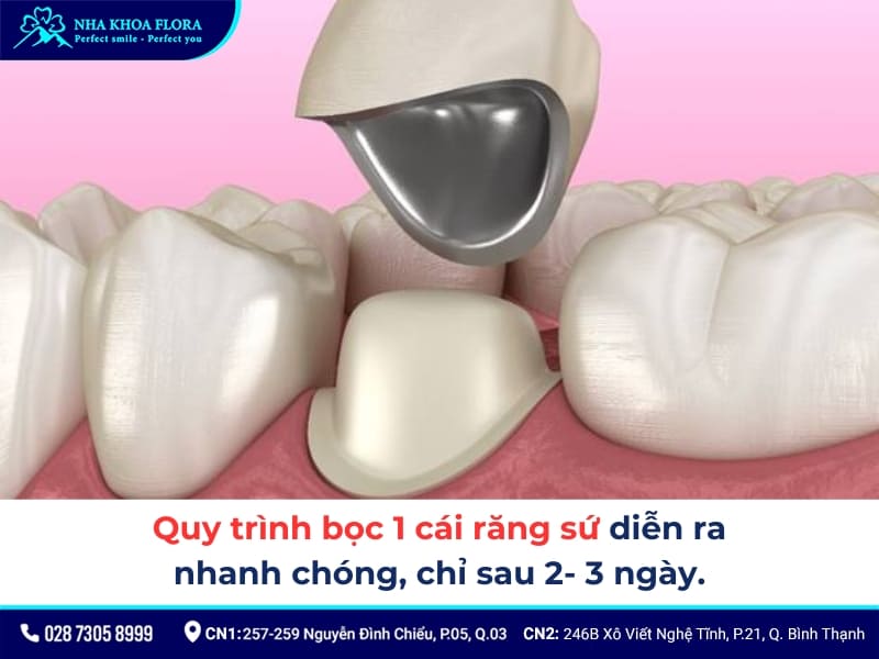 bọc răng sứ 1 chiếc được không