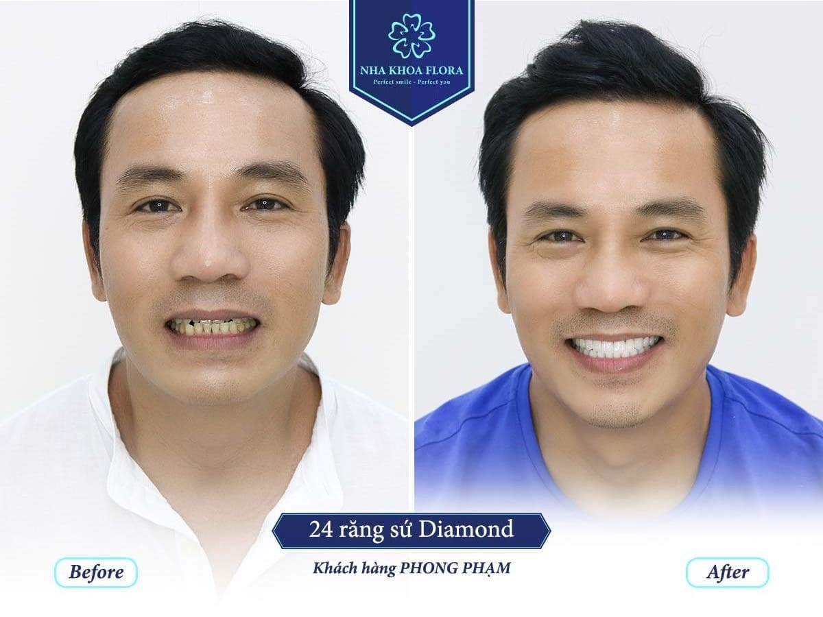 Răng sứ bao lâu thì ăn được? (ảnh minh họa)