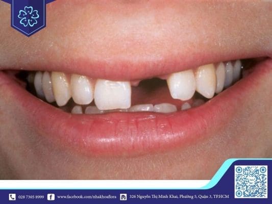 trồng răng implant giá rẻ phụ thuộc vào số lượng răng mất