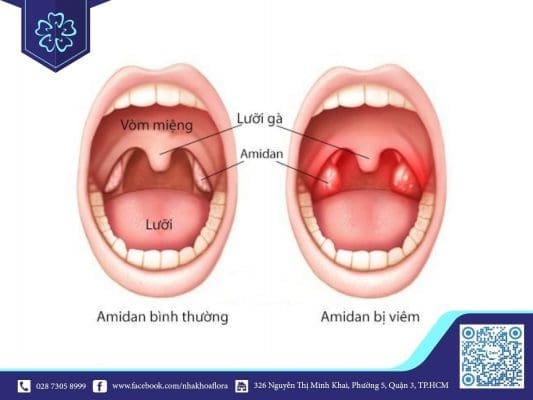 Viêm amidan là một trong những nguyên nhân gây hôi miệng (ảnh minh họa)