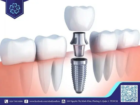 MẤT RĂNG HÀM DƯỚI LÂU NĂM CÓ TRỒNG RĂNG IMPLANT ĐƯỢC KHÔNG? 1