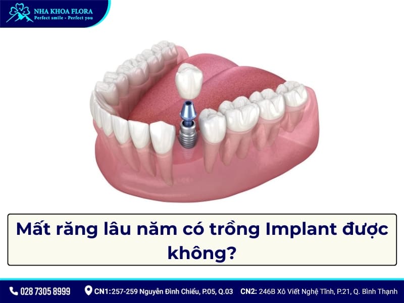mất răng lâu năm có trồng Implant được không