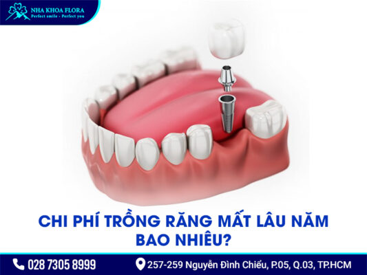 Chi phí trồng răng Implant