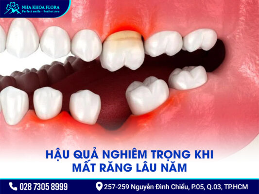 Tác hại khi bị mất răng lâu năm